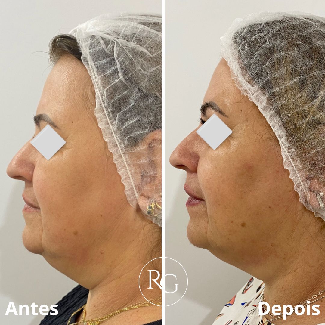 Resultado Ultraformer - Dra. Roberta Godoi